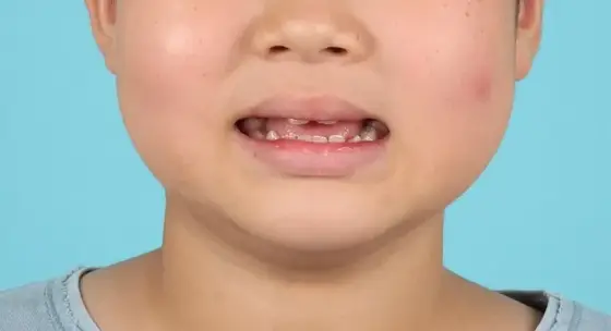 소아 개방교합 사례 01(1·2차 교정) 치료 전 얼굴 정면 사진