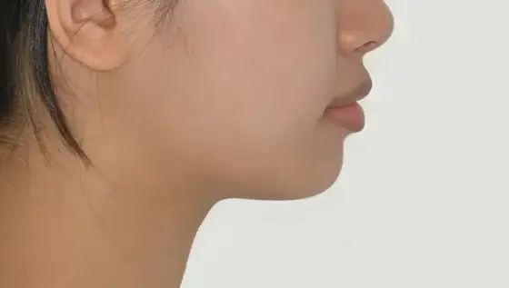 무턱 성장 유도 사례 03(기능 장치) 치료 후 얼굴 옆모습 사진 – 교합과 옆모습 함께 개선, 치료기간 10개월