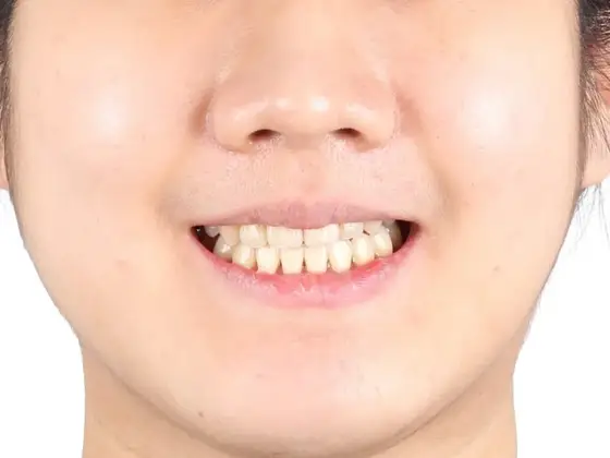 주걱턱 (수술) 사례 01(수술 교정) 치료 후 얼굴 정면 사진 – 위·아래턱 차이 개선, 치료기간 32개월