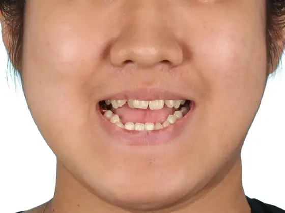 주걱턱 (수술) 사례 01(수술 교정) 치료 전 얼굴 정면 사진