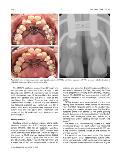 이지민 원장 제1저자 논문 지면 – The Angle Orthodontist 2023년 93권 2호 「Evaluation of miniscrew-assisted rapid palatal expansion success by comparing width of circummaxillary sutures before expansion in adult male patients」. 성인 남성 40명의 CBCT로 위턱 주변 봉합 10곳의 폭을 비교해 비수술 악궁확장(MARPE) 성공을 예측하는 기준을 제시한 연구